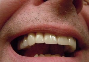 What is bad breath:definition, cause, remedy 