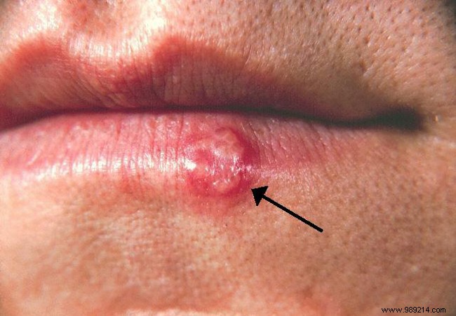 The cold sore:what is it, how to treat it? 