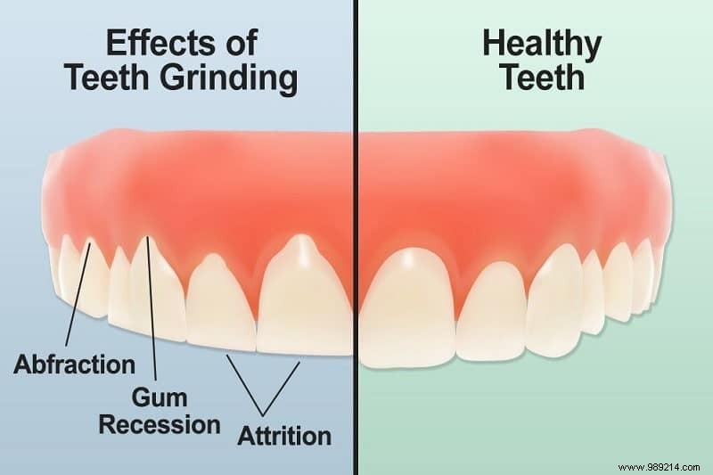 Why do some people suffer from bruxism? (uncontrolled teeth grinding) 