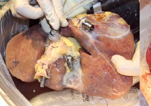 They kept human livers outside the body for a week 