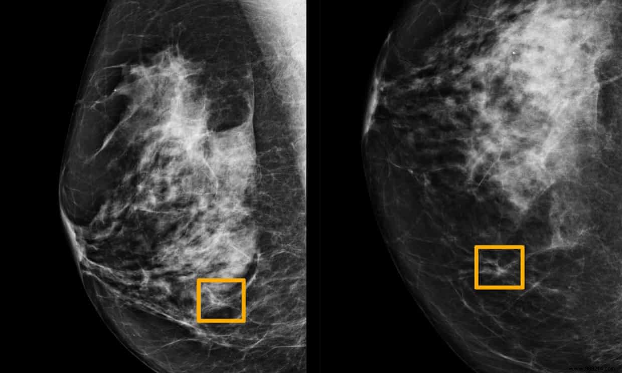 AI more effective than humans in detecting breast cancer 