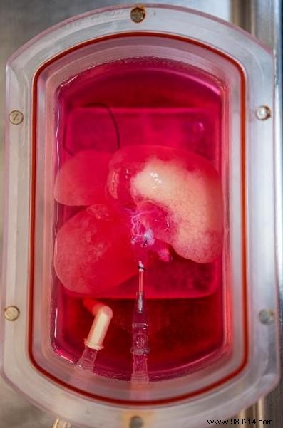 Miniature human livers successfully transplanted into rats 