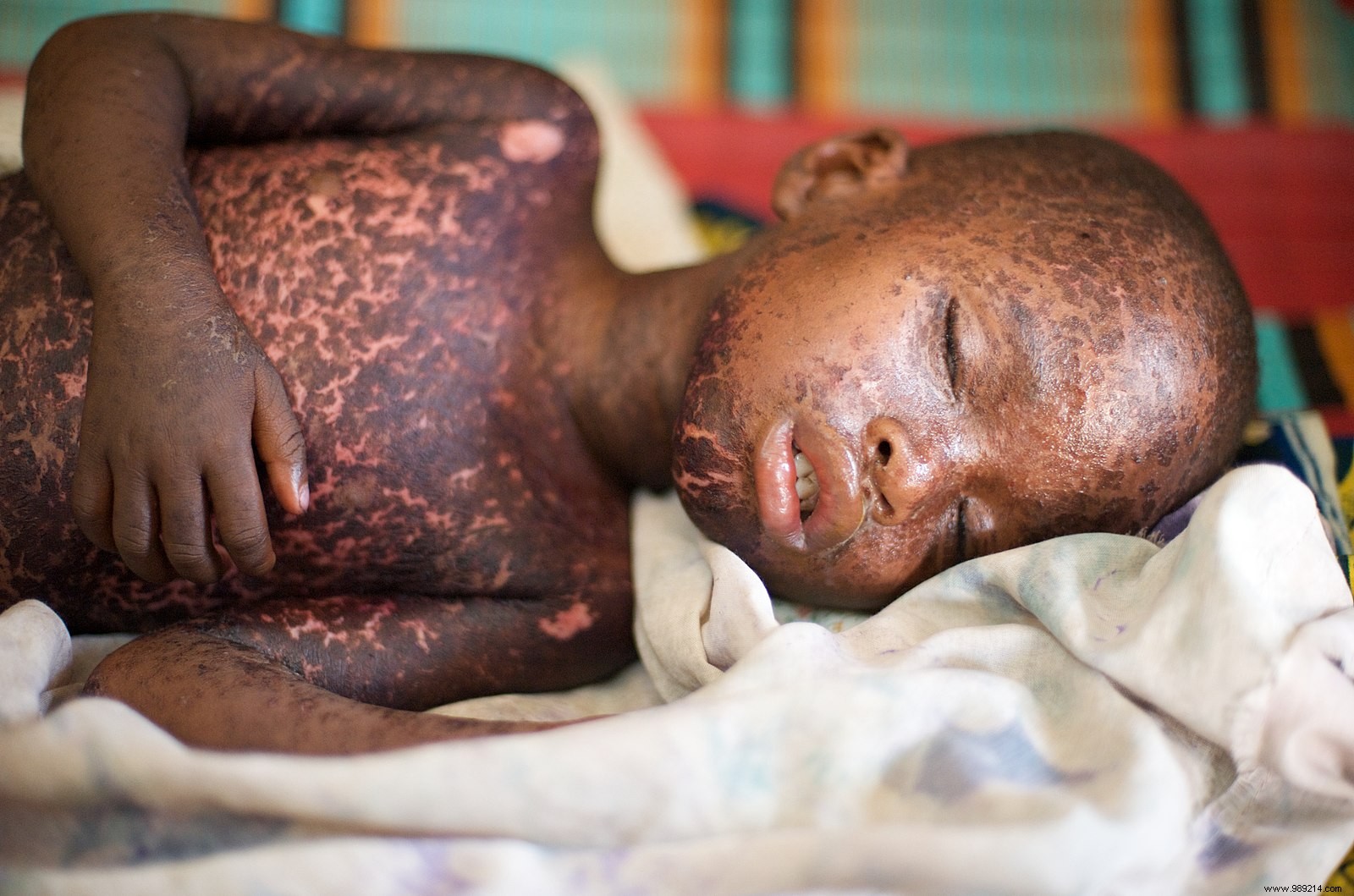 Measles killed at least 200,000 people worldwide in 2019 