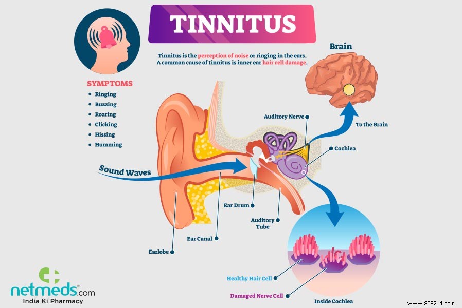 This promising treatment could cure tinnitus, study finds 