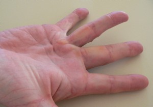 What is Dupuytren s disease, mainly affecting Icelanders? 