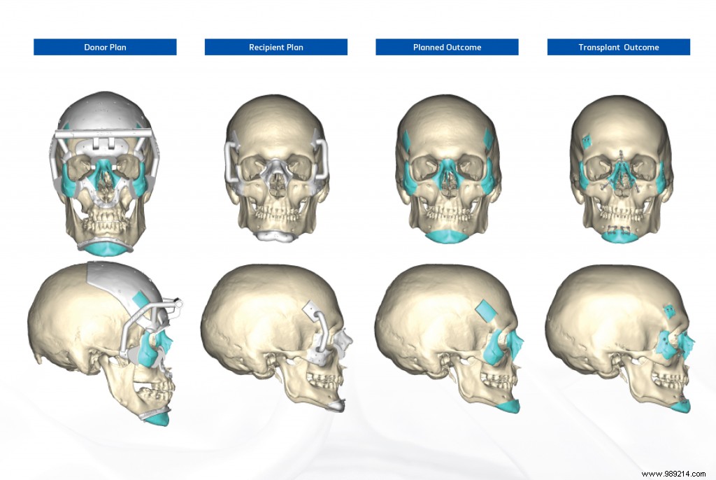 They perform a double hand and face transplant using 3D printing 