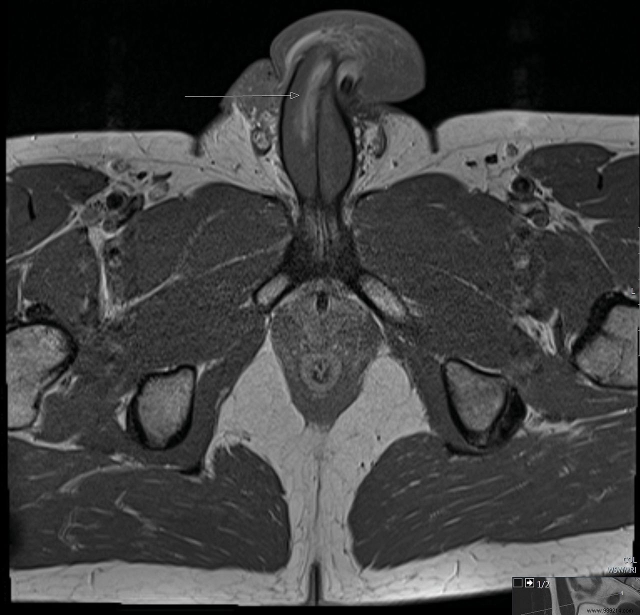 Case Study:First  Vertical Fracture  of Penis Reported 