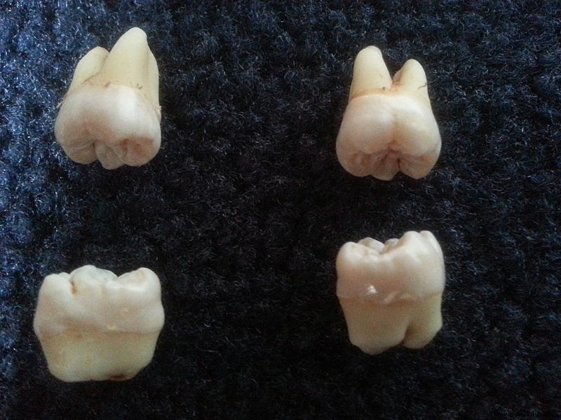 This Study Explains Why Wisdom Teeth Only Grow in Adulthood 