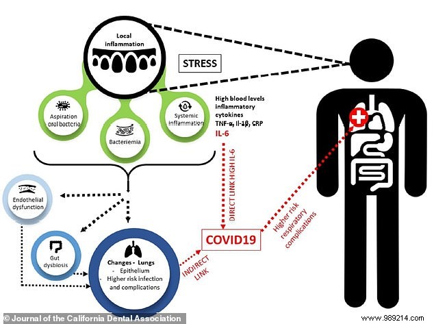 Covid-19:poor oral health increases the risk of serious forms 