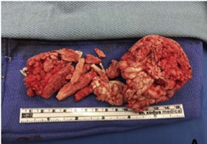 Urology Case Report: Insulating Foam Obstructs Urethra After DIY Erectile Dysfunction Attempt