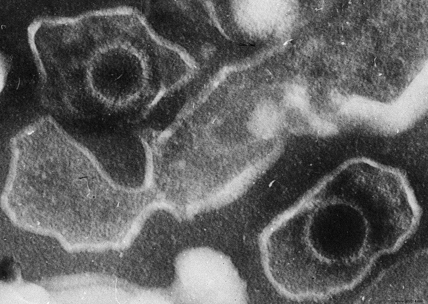 A Very Common Virus May Trigger Multiple Sclerosis 